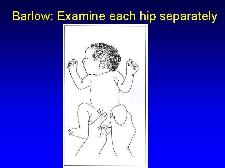 Barlow: Examine each hip separately 