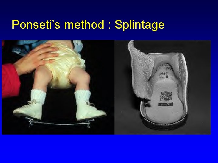 Ponseti’s method : Splintage 