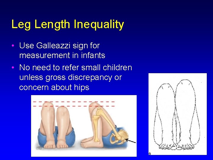 Leg Length Inequality • Use Galleazzi sign for measurement in infants • No need