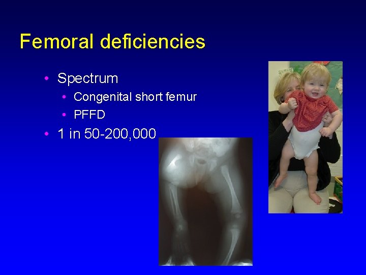 Femoral deficiencies • Spectrum • Congenital short femur • PFFD • 1 in 50
