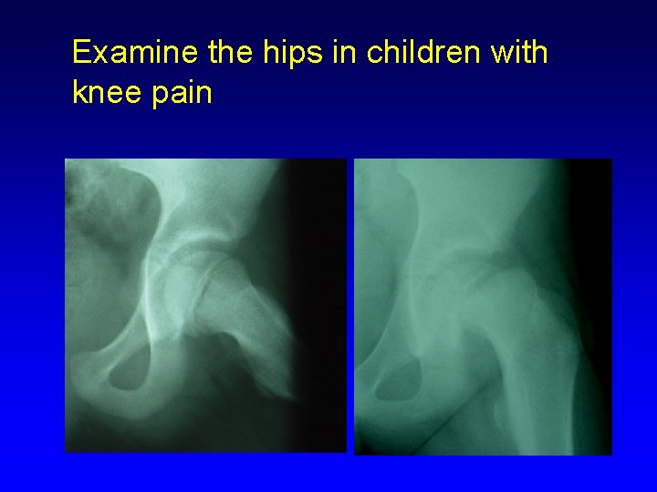 Examine the hips in children with knee pain 