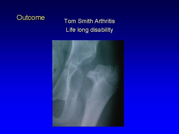 Outcome Tom Smith Arthritis Life long disability 