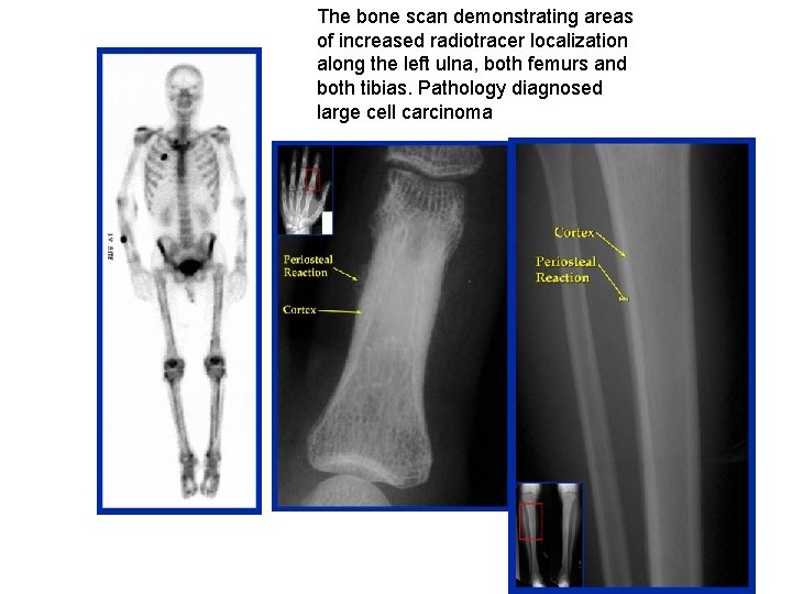 The bone scan demonstrating areas of increased radiotracer localization along the left ulna, both