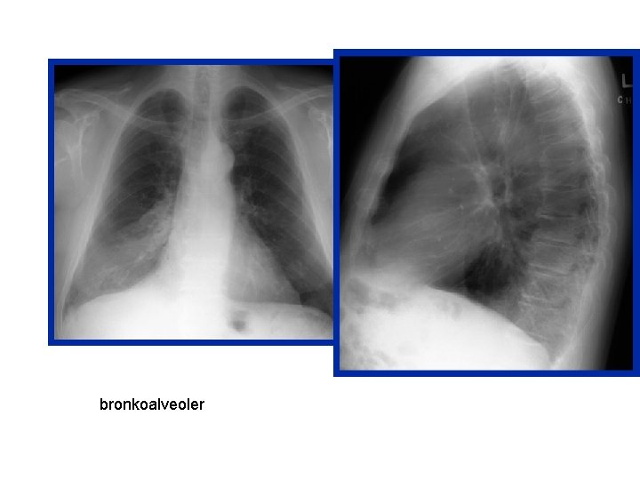 bronkoalveoler 