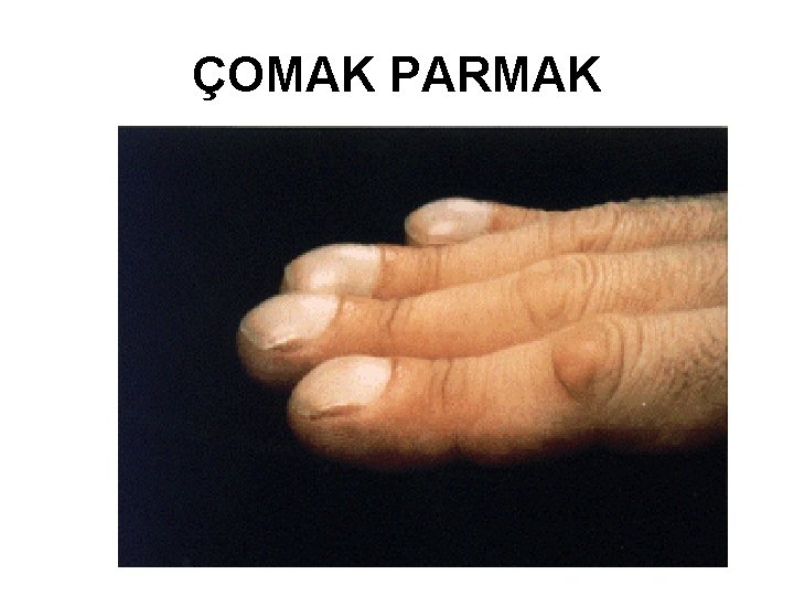 ÇOMAK PARMAK 