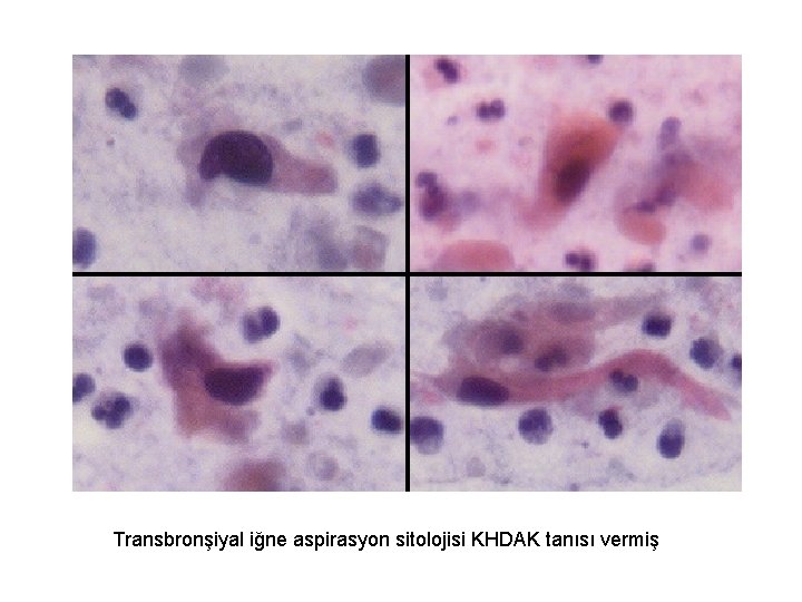 Transbronşiyal iğne aspirasyon sitolojisi KHDAK tanısı vermiş 