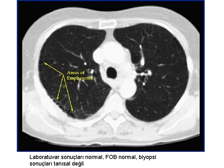 Laboratuvar sonuçları normal, FOB normal, biyopsi sonuçları tanısal değil 