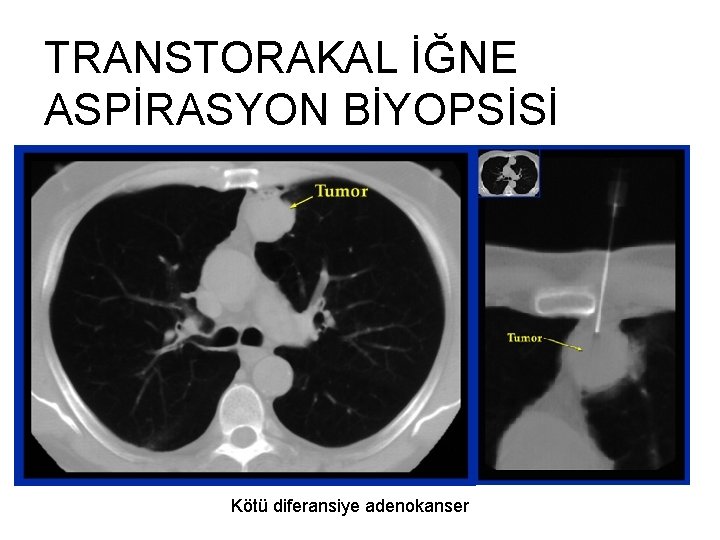 TRANSTORAKAL İĞNE ASPİRASYON BİYOPSİSİ Kötü diferansiye adenokanser 