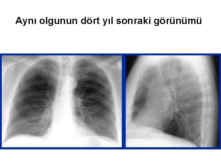 Aynı olgunun dört yıl sonraki görünümü 