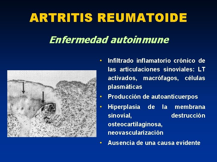 ARTRITIS REUMATOIDE Enfermedad autoinmune • Infiltrado inflamatorio crónico de las articulaciones sinoviales: LT activados,