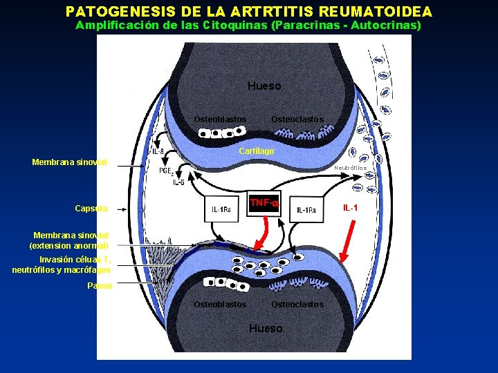 PATOGENESIS DE LA ARTRTITIS REUMATOIDEA Amplificación de las Citoquinas (Paracrinas - Autocrinas) Hueso Osteoblastos