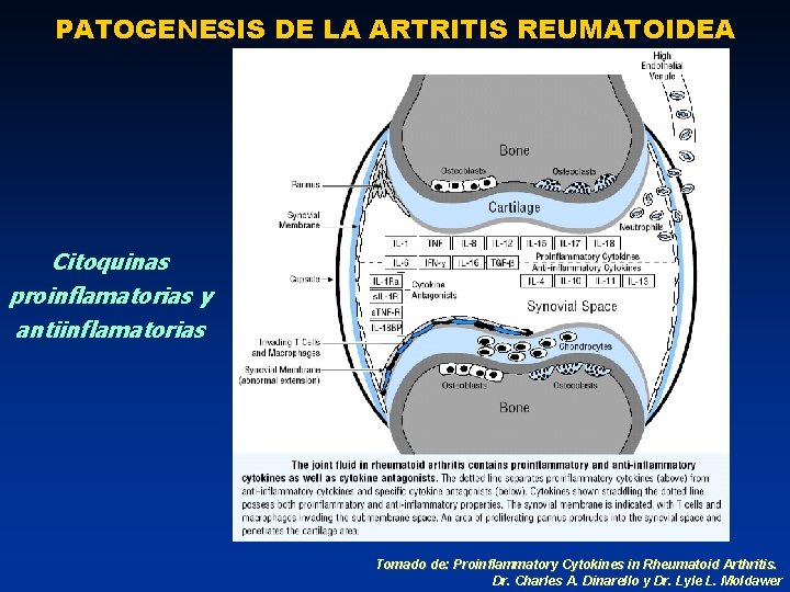 PATOGENESIS DE LA ARTRITIS REUMATOIDEA Citoquinas proinflamatorias y antiinflamatorias Tomado de: Proinflammatory Cytokines in