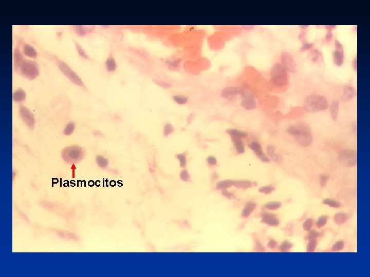 Plasmocitos 