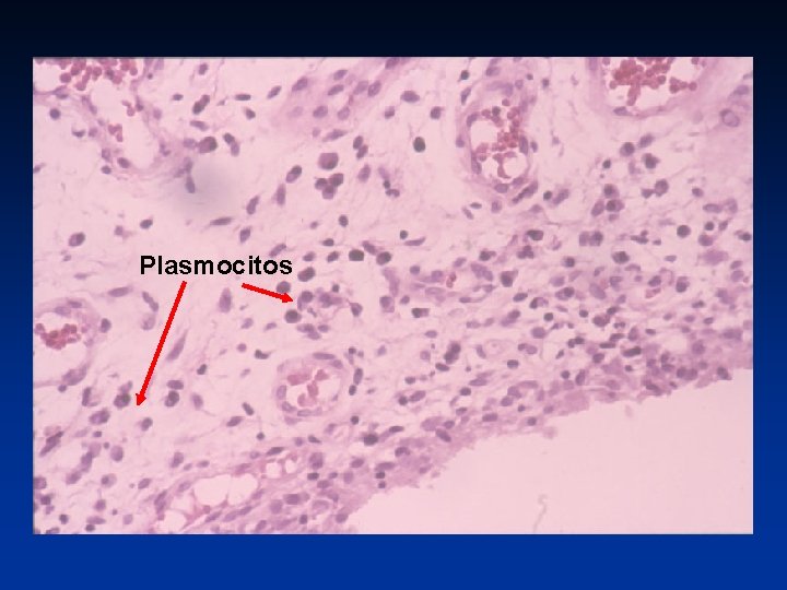Plasmocitos 