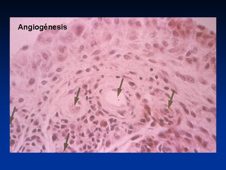 Angiogénesis 