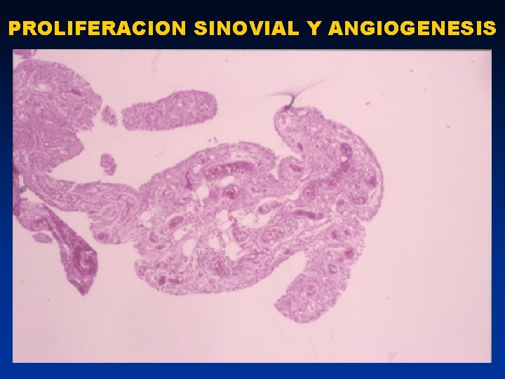 PROLIFERACION SINOVIAL Y ANGIOGENESIS 