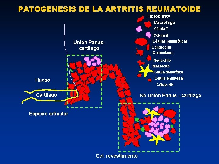 PATOGENESIS DE LA ARTRITIS REUMATOIDE Fibroblasto Macrófago Célula T Célula B Unión Panuscartílago Células