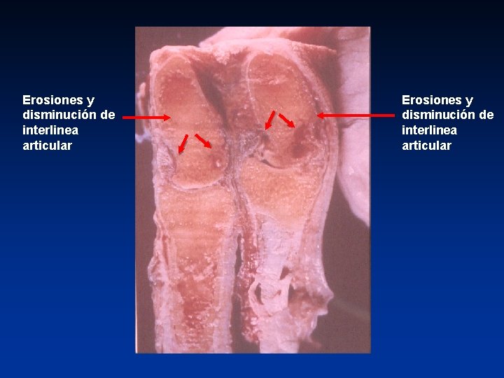 Erosiones y disminución de interlinea articular 