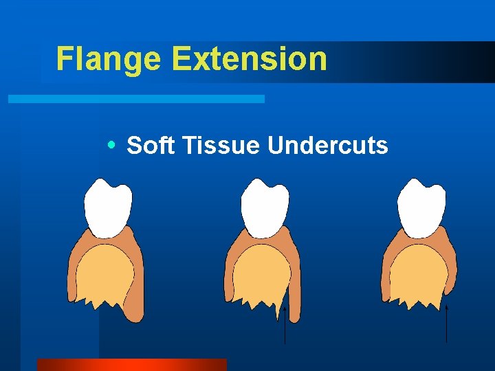 Flange Extension Soft Tissue Undercuts 