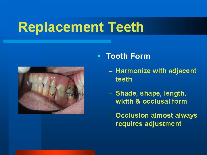 Replacement Teeth Tooth Form – Harmonize with adjacent teeth – Shade, shape, length, width