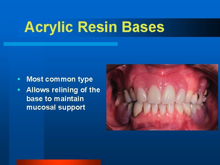 Acrylic Resin Bases Most common type Allows relining of the base to maintain mucosal