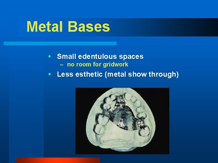 Metal Bases Small edentulous spaces – no room for gridwork Less esthetic (metal show