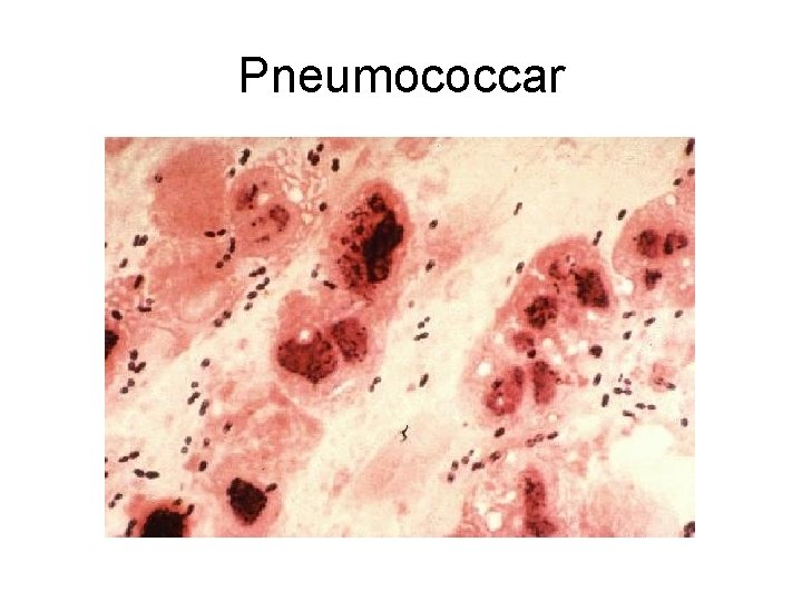 Pneumococcar 