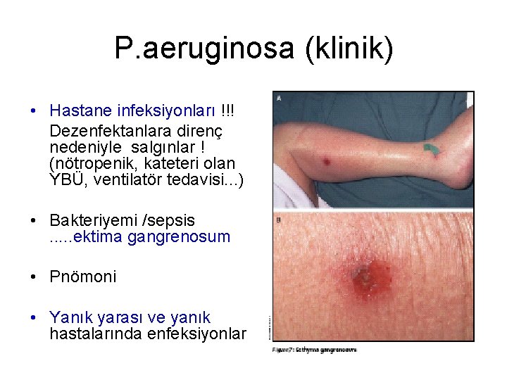 P. aeruginosa (klinik) • Hastane infeksiyonları !!! Dezenfektanlara direnç nedeniyle salgınlar ! (nötropenik, kateteri