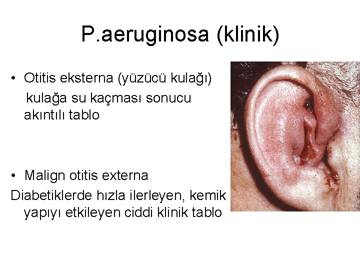 P. aeruginosa (klinik) • Otitis eksterna (yüzücü kulağı) kulağa su kaçması sonucu akıntılı tablo