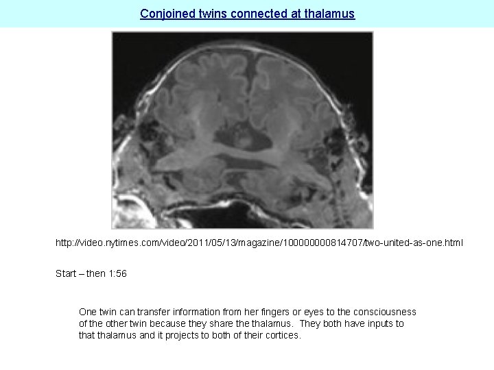 Conjoined twins connected at thalamus http: //video. nytimes. com/video/2011/05/13/magazine/10000814707/two-united-as-one. html Start – then 1: