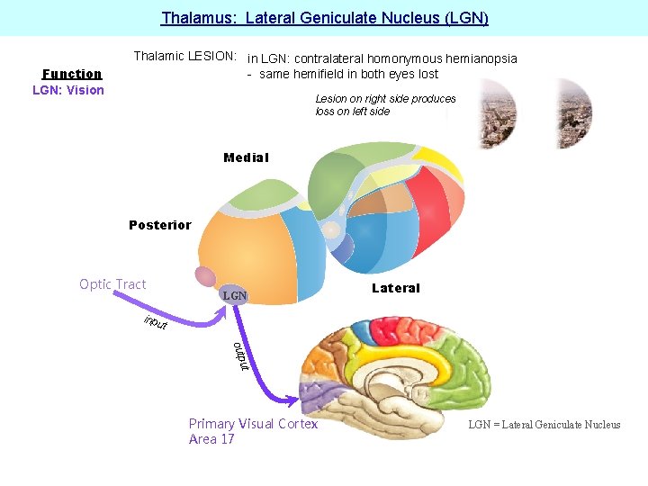 Thalamus: Lateral Geniculate Nucleus (LGN) Function LGN: Vision Thalamic LESION: in LGN: contralateral homonymous