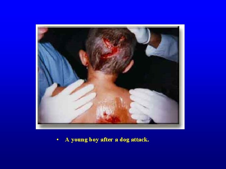  • A young boy after a dog attack. 