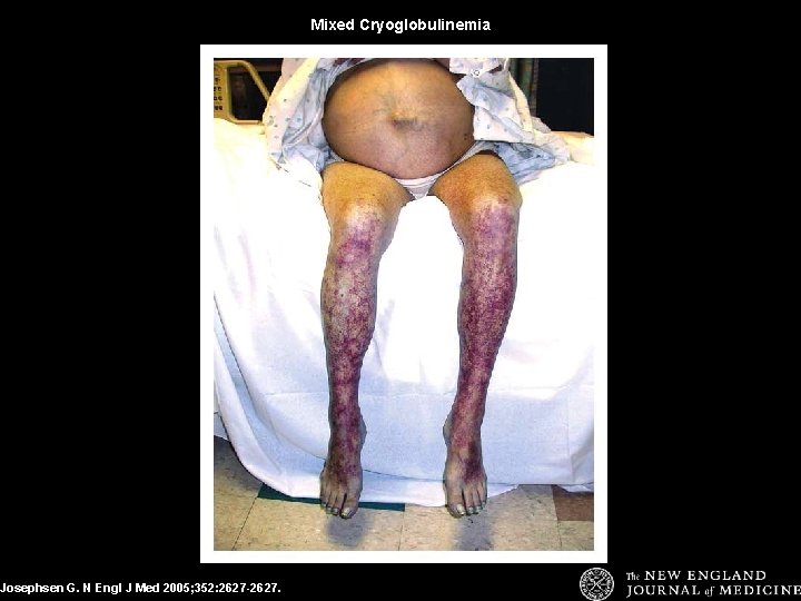 Josephsen G. N Engl J Med 2005; 352: 2627 -2627. Mixed Cryoglobulinemia 