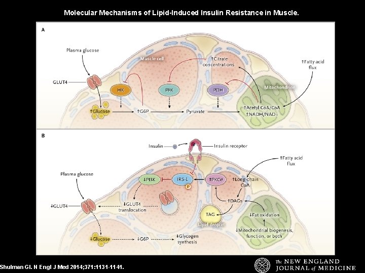 Molecular Mechanisms of Lipid-Induced Insulin Resistance in Muscle. Shulman GI. N Engl J Med