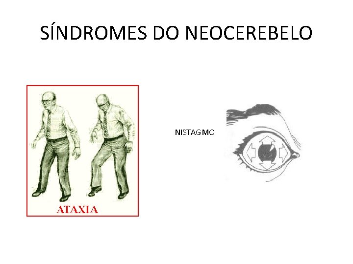 SÍNDROMES DO NEOCEREBELO NISTAGMO 