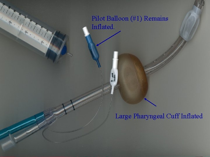 Pilot Balloon (#1) Remains Inflated. Large Pharyngeal Cuff Inflated 