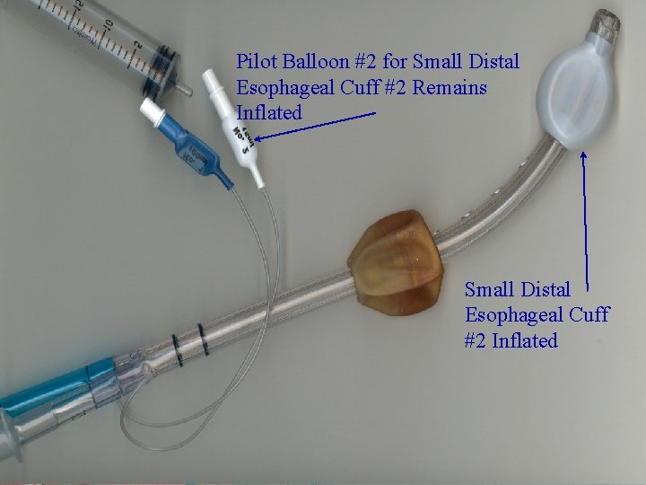 Pilot Balloon #2 for Small Distal Esophageal Cuff #2 Remains Inflated Small Distal Esophageal
