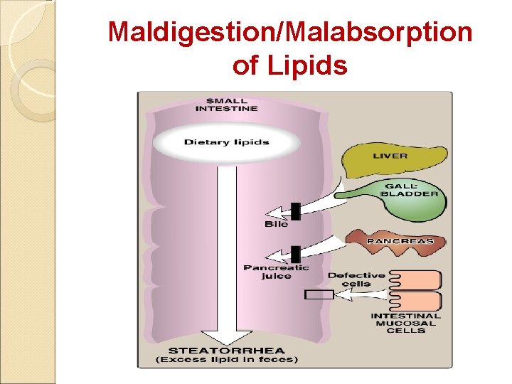 Maldigestion/Malabsorption of Lipids 