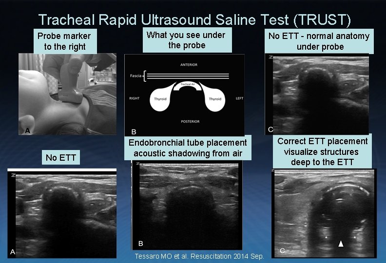 Tracheal Rapid Ultrasound Saline Test (TRUST) Probe marker to the right No ETT What
