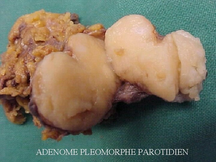 ADENOME PLEOMORPHE PAROTIDIEN 