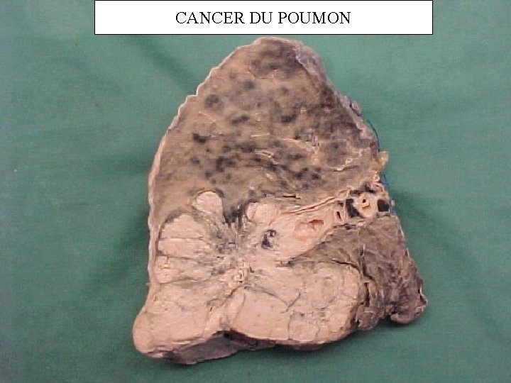 CANCER DU POUMON 