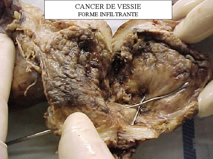 CANCER DE VESSIE FORME INFILTRANTE 