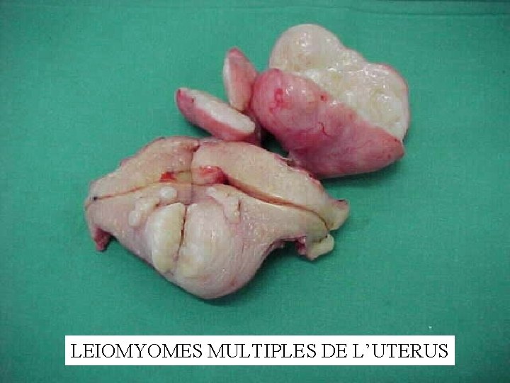 LEIOMYOMES MULTIPLES DE L’UTERUS 