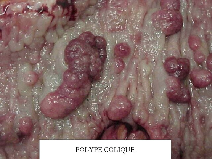 POLYPE COLIQUE 