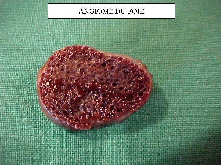 ANGIOME DU FOIE 