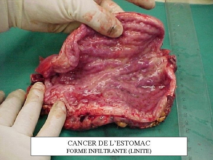 CANCER DE L’ESTOMAC FORME INFILTRANTE (LINITE) 