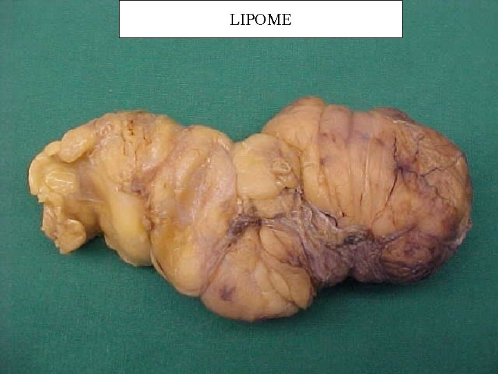 LIPOME 