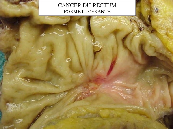 CANCER DU RECTUM FORME ULCERANTE 