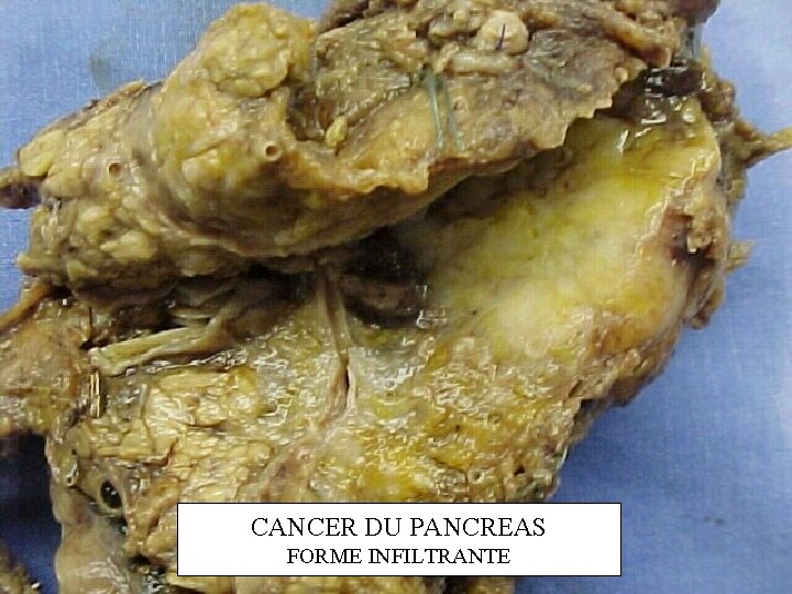 CANCER DU PANCREAS FORME INFILTRANTE 