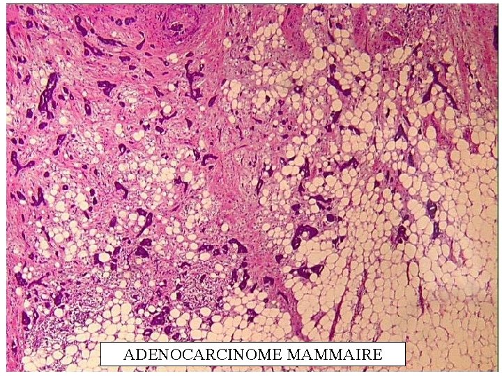 ADENOCARCINOME MAMMAIRE 